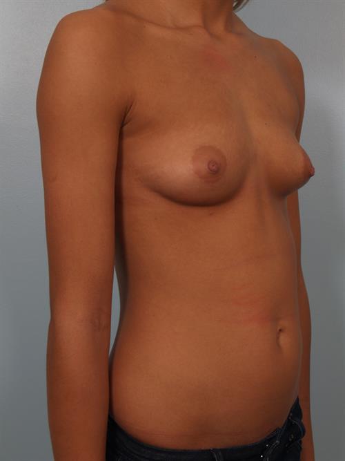 Breast Augmentation Before Photo | Phoenix and Scottsdale, AZ | Scottsdale Center for Plastic Surgery