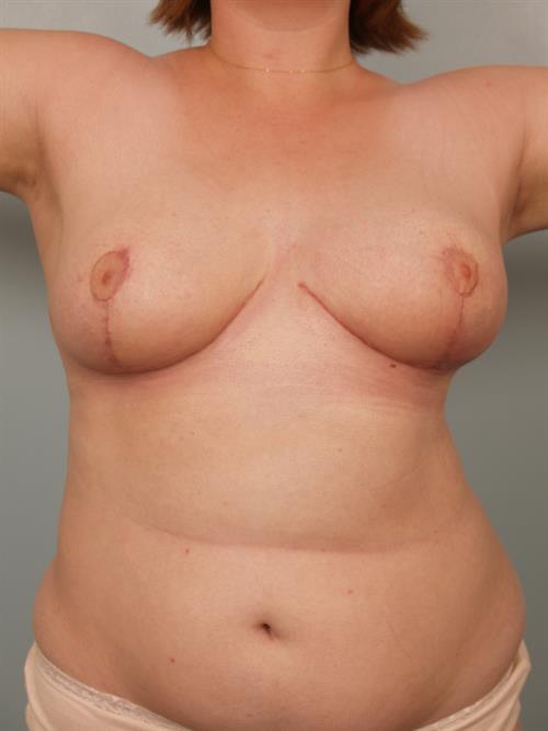 Breast Reduction After Photo | Phoenix and Scottsdale, AZ | Scottsdale Center for Plastic Surgery
