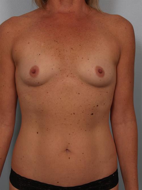 Breast Augmentation Before Photo | Phoenix and Scottsdale, AZ | Scottsdale Center for Plastic Surgery