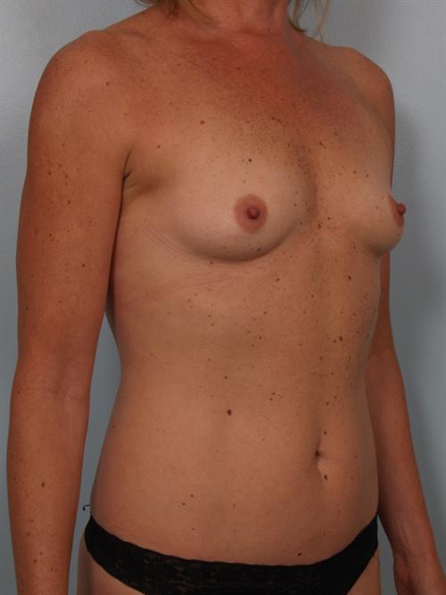 Breast Augmentation Before Photo | Phoenix and Scottsdale, AZ | Scottsdale Center for Plastic Surgery