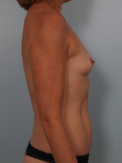 Breast Augmentation Before Photo | Phoenix and Scottsdale, AZ | Scottsdale Center for Plastic Surgery