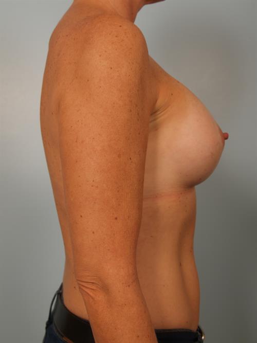 Breast Augmentation After Photo | Phoenix and Scottsdale, AZ | Scottsdale Center for Plastic Surgery