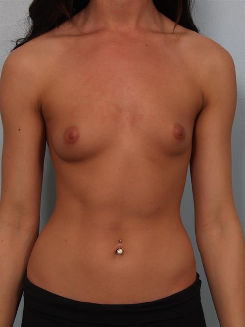 Breast Augmentation Before Photo | Phoenix and Scottsdale, AZ | Scottsdale Center for Plastic Surgery