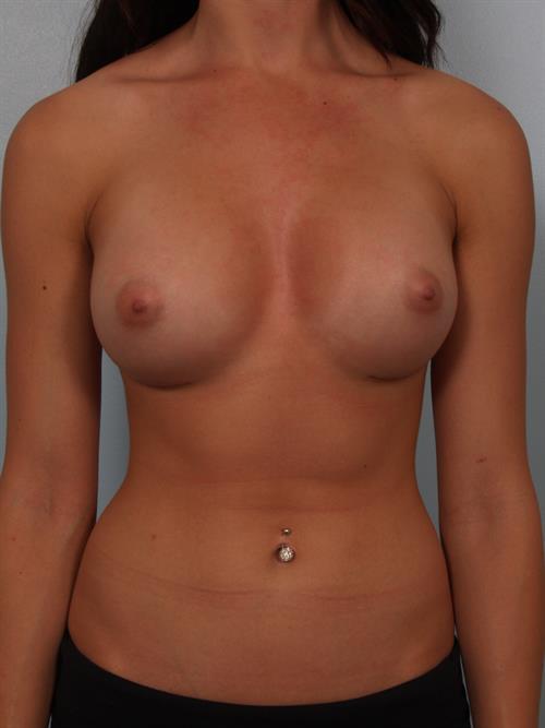 Breast Augmentation After Photo | Phoenix and Scottsdale, AZ | Scottsdale Center for Plastic Surgery