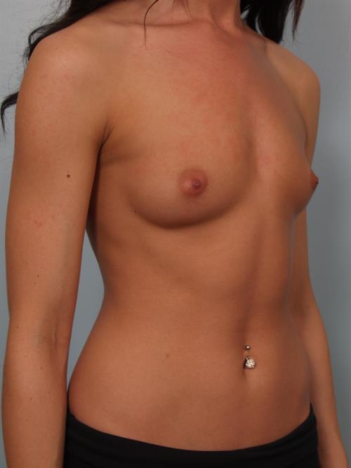 Breast Augmentation Before Photo | Phoenix and Scottsdale, AZ | Scottsdale Center for Plastic Surgery