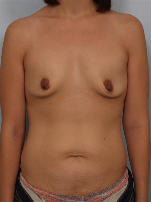 Breast Augmentation Before Photo | Phoenix and Scottsdale, AZ | Scottsdale Center for Plastic Surgery