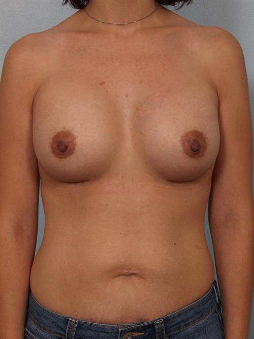 Breast Augmentation After Photo | Phoenix and Scottsdale, AZ | Scottsdale Center for Plastic Surgery