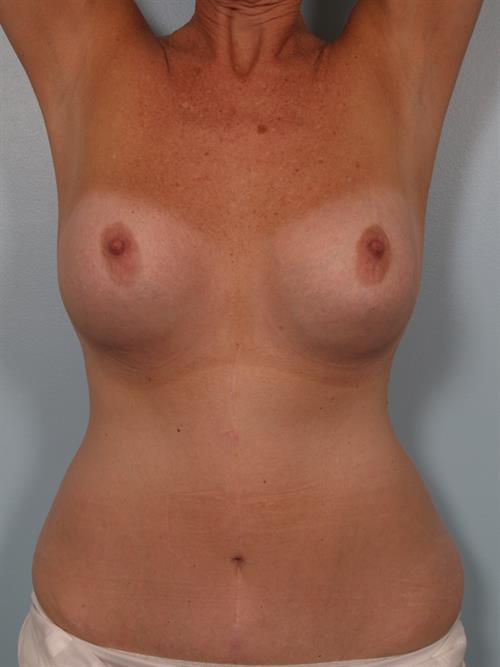 Revision Breast Surgery Before Photo | Phoenix and Scottsdale, AZ | Scottsdale Center for Plastic Surgery