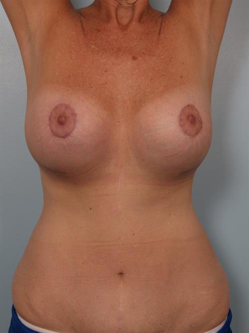 Revision Breast Surgery After Photo | Phoenix and Scottsdale, AZ | Scottsdale Center for Plastic Surgery