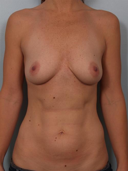 Breast Augmentation Before Photo | Phoenix and Scottsdale, AZ | Scottsdale Center for Plastic Surgery