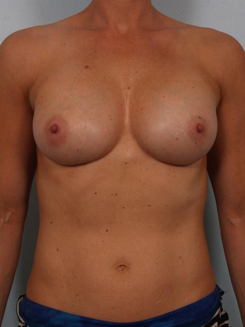 Revision Breast Surgery After Photo | Phoenix and Scottsdale, AZ | Scottsdale Center for Plastic Surgery