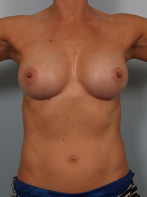 Revision Breast Surgery After Photo | Phoenix and Scottsdale, AZ | Scottsdale Center for Plastic Surgery