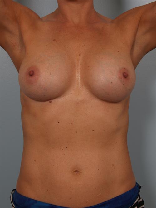Revision Breast Surgery After Photo | Phoenix and Scottsdale, AZ | Scottsdale Center for Plastic Surgery