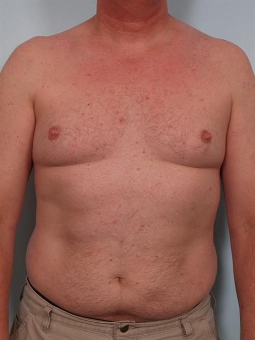 Male Breast/Areola Reduction Before Photo | Phoenix and Scottsdale, AZ | Scottsdale Center for Plastic Surgery