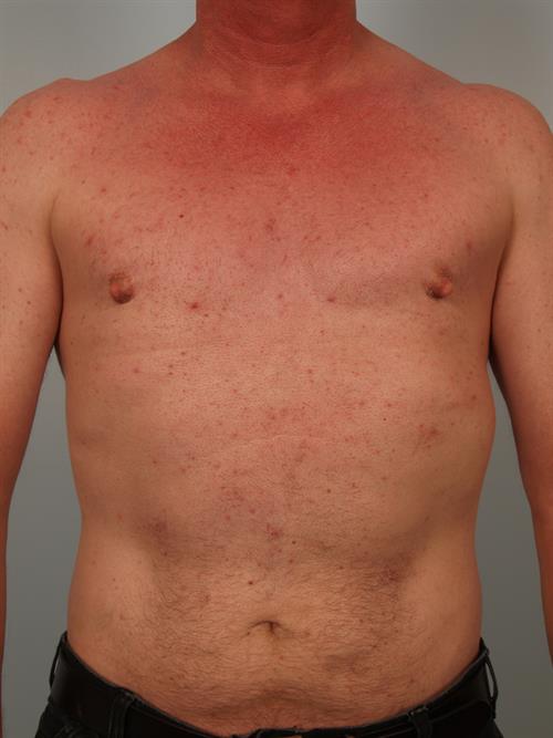 Male Breast/Areola Reduction After Photo | Phoenix and Scottsdale, AZ | Scottsdale Center for Plastic Surgery