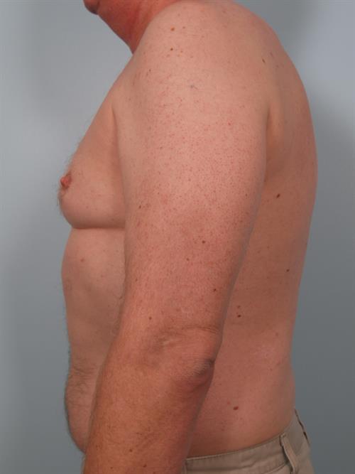 Male Breast/Areola Reduction Before Photo | Phoenix and Scottsdale, AZ | Scottsdale Center for Plastic Surgery
