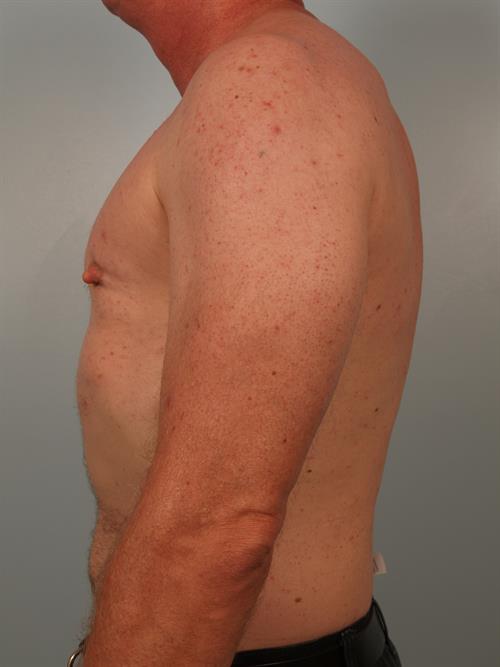 Male Breast/Areola Reduction After Photo | Phoenix and Scottsdale, AZ | Scottsdale Center for Plastic Surgery