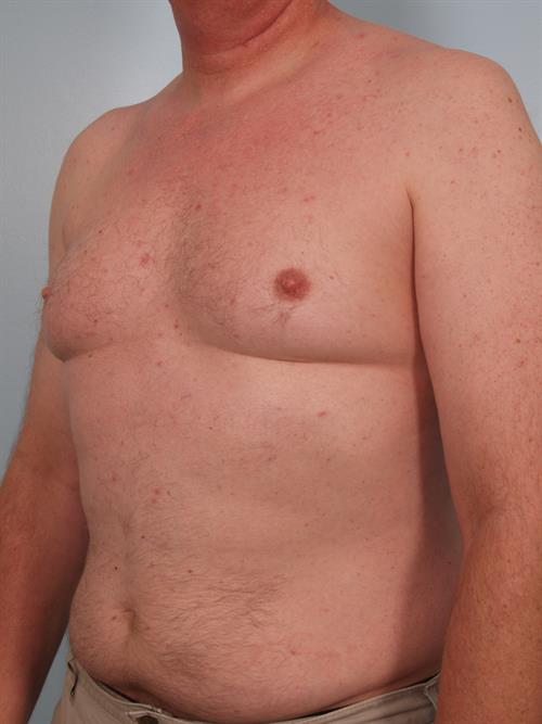 Male Breast/Areola Reduction Before Photo | Phoenix and Scottsdale, AZ | Scottsdale Center for Plastic Surgery