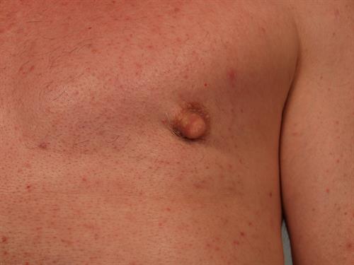 Male Breast/Areola Reduction After Photo | Phoenix and Scottsdale, AZ | Scottsdale Center for Plastic Surgery