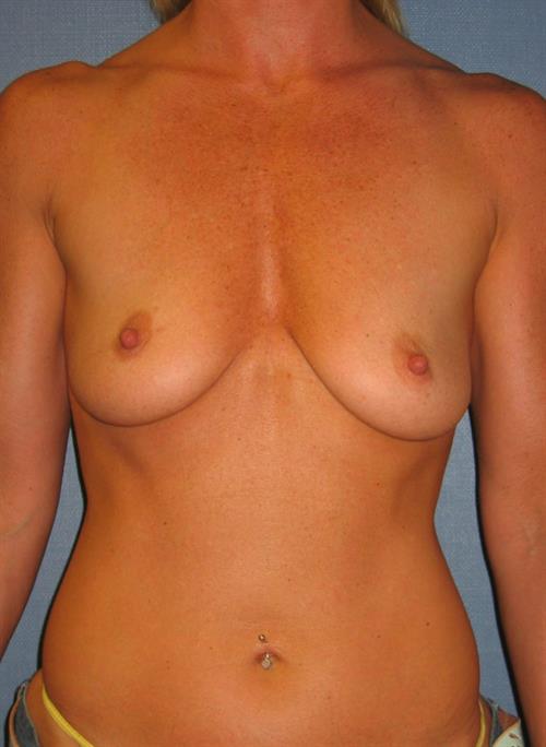 Breast Augmentation Before Photo | Paradise Valley, AZ | Scottsdale Center for Plastic Surgery