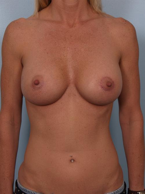 Breast Lift (Mastopexy) with Implants After Photo | ,  | 