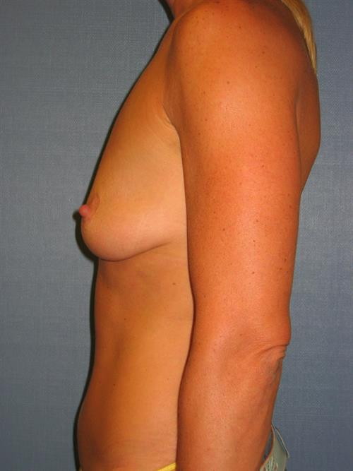 Breast Lift (Mastopexy) with Implants Before Photo | Phoenix and Scottsdale, AZ | Scottsdale Center for Plastic Surgery
