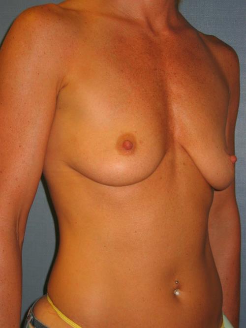 Breast Lift (Mastopexy) with Implants Before Photo | Phoenix and Scottsdale, AZ | Scottsdale Center for Plastic Surgery