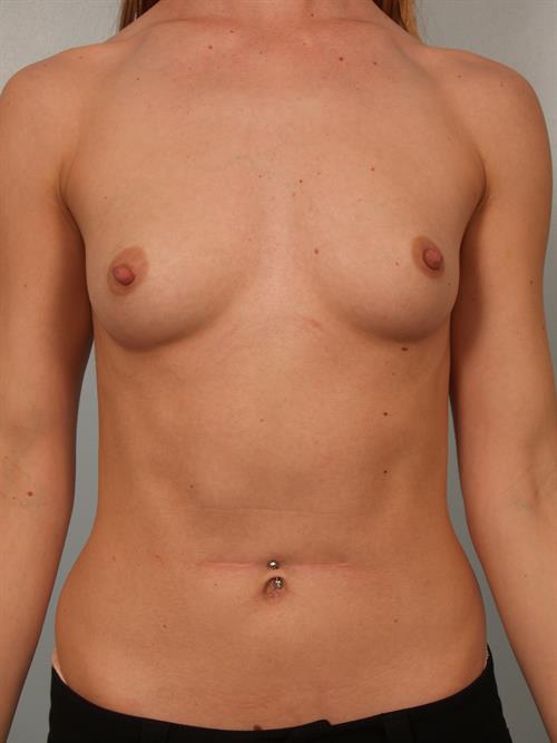 Breast Augmentation Before Photo | Phoenix and Scottsdale, AZ | Scottsdale Center for Plastic Surgery