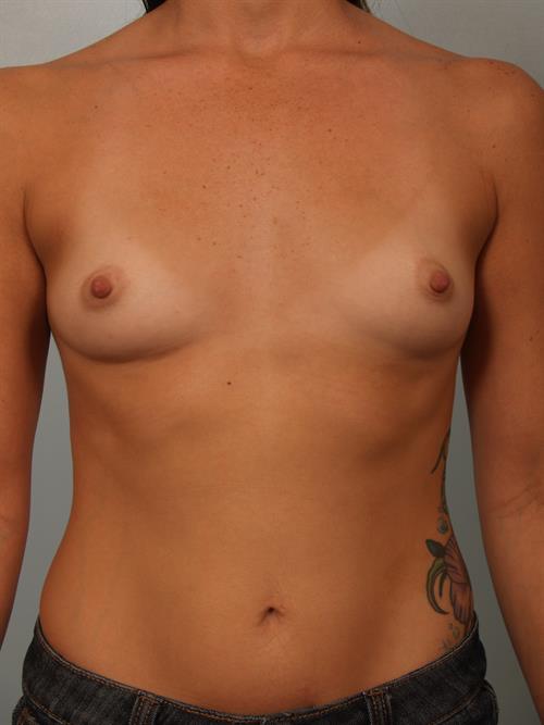 Breast Augmentation Before Photo | Phoenix and Scottsdale, AZ | Scottsdale Center for Plastic Surgery