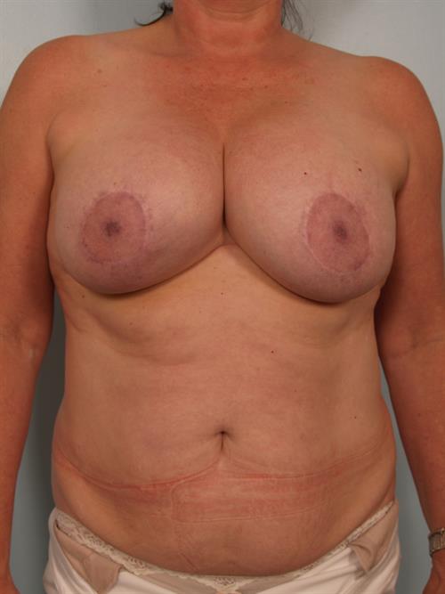 Breast Lift (Mastopexy) Before Photo | Phoenix and Scottsdale, AZ | Scottsdale Center for Plastic Surgery
