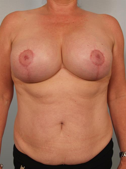 Breast Lift (Mastopexy) After Photo | Phoenix and Scottsdale, AZ | Scottsdale Center for Plastic Surgery