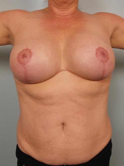 Breast Augmentation After Photo | Phoenix and Scottsdale, AZ | Scottsdale Center for Plastic Surgery