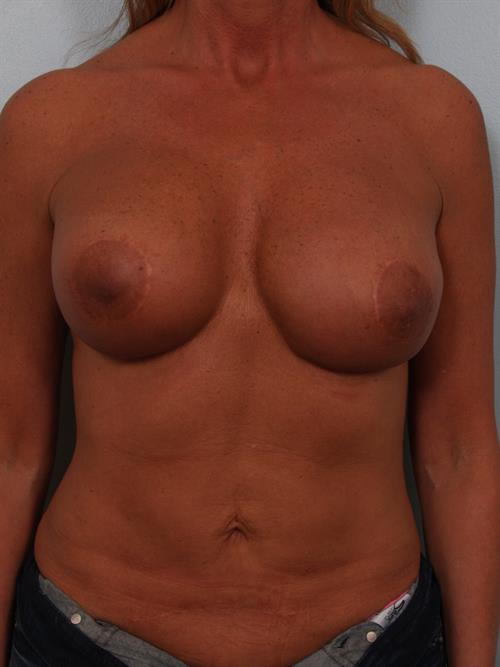 Revision Breast Surgery Before Photo | Phoenix and Scottsdale, AZ | Scottsdale Center for Plastic Surgery