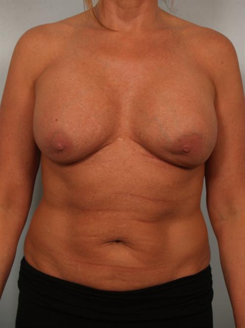 Fat Grafting Before Photo | Phoenix and Scottsdale, AZ | Scottsdale Center for Plastic Surgery