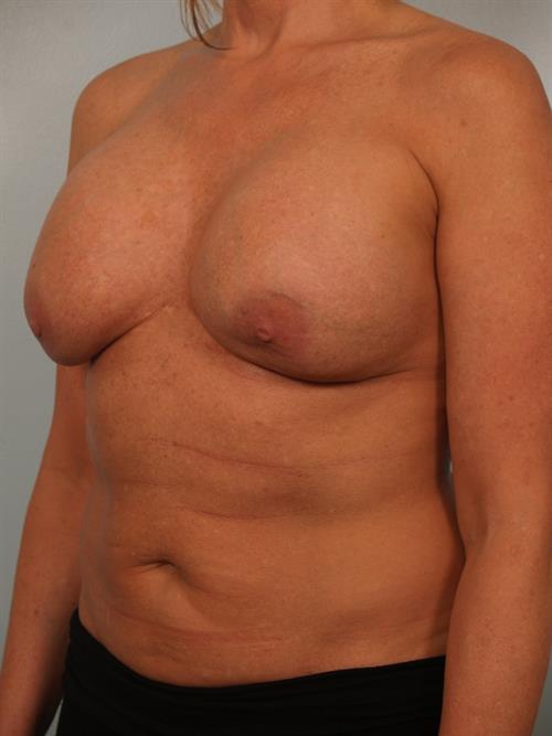 Fat Grafting Before Photo | Phoenix and Scottsdale, AZ | Scottsdale Center for Plastic Surgery