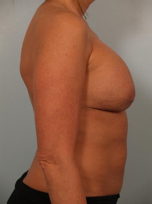 Fat Grafting Before Photo | Phoenix and Scottsdale, AZ | Scottsdale Center for Plastic Surgery