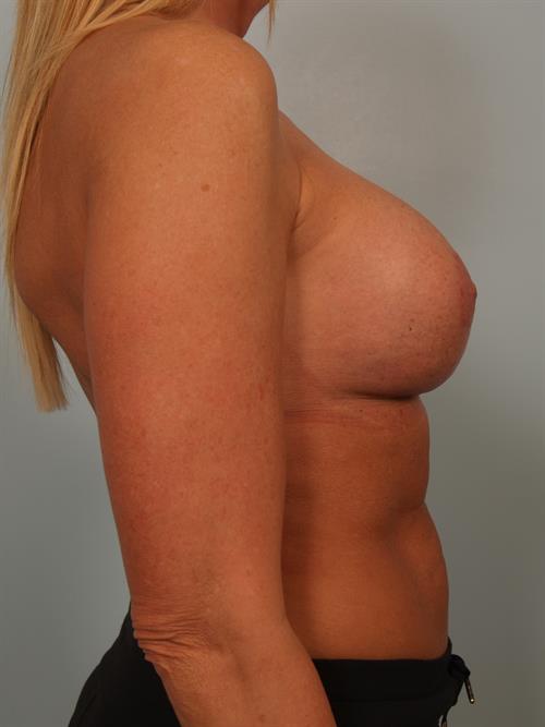 Fat Grafting After Photo | Phoenix and Scottsdale, AZ | Scottsdale Center for Plastic Surgery