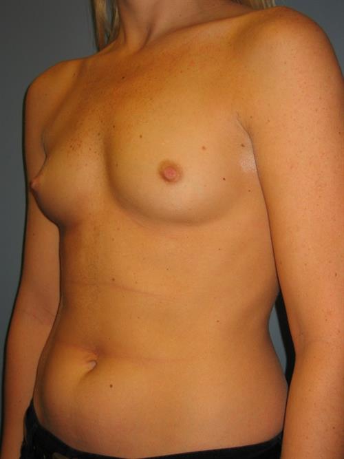 Breast Augmentation Before Photo | Phoenix and Scottsdale, AZ | Scottsdale Center for Plastic Surgery