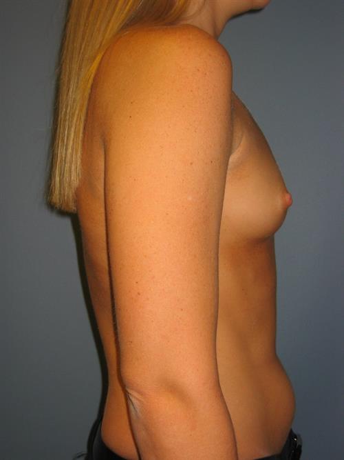 Breast Augmentation Before Photo | Phoenix and Scottsdale, AZ | Scottsdale Center for Plastic Surgery