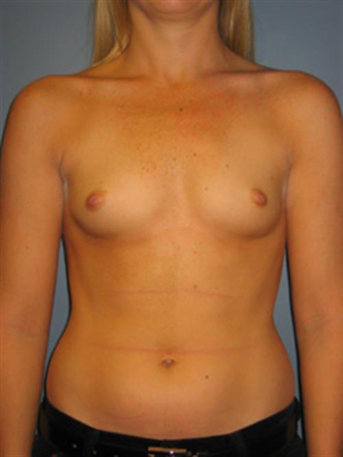 Breast Augmentation Before Photo | Phoenix and Scottsdale, AZ | Scottsdale Center for Plastic Surgery