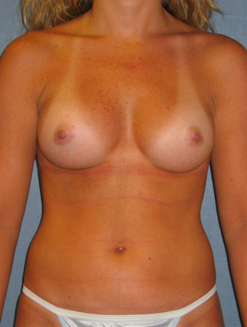 Breast Augmentation After Photo | Phoenix and Scottsdale, AZ | Scottsdale Center for Plastic Surgery