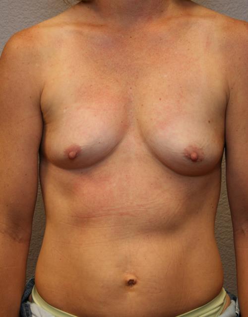 Breast Augmentation Before Photo | Phoenix and Scottsdale, AZ | Scottsdale Center for Plastic Surgery