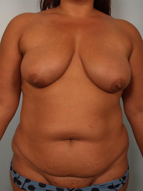 Mommy Makeover Before Photo | , |