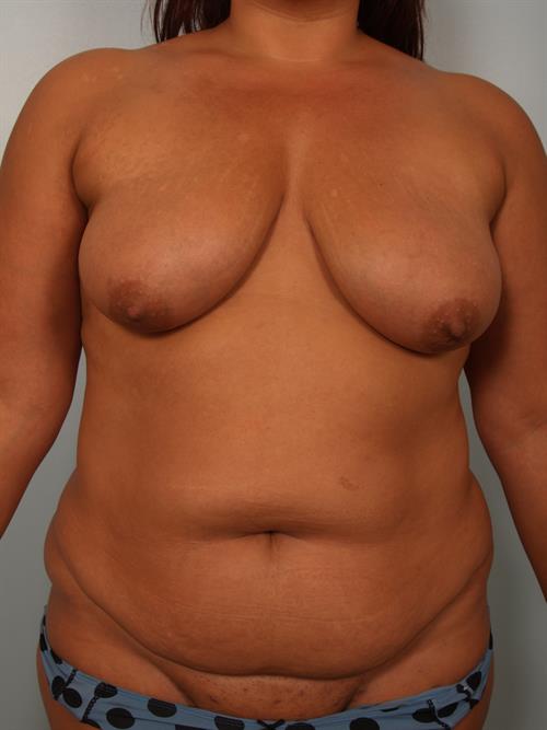 Power Assisted Liposuction Before Photo | ,  | 