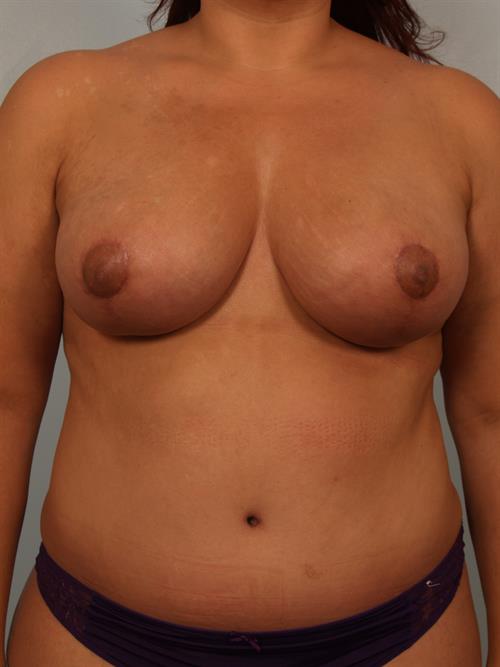 Mommy Makeover After Photo | , |