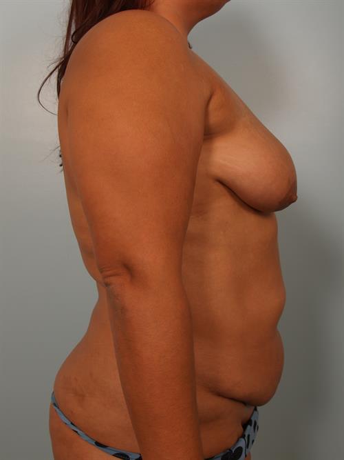 Power Assisted Liposuction Before Photo | ,  | 