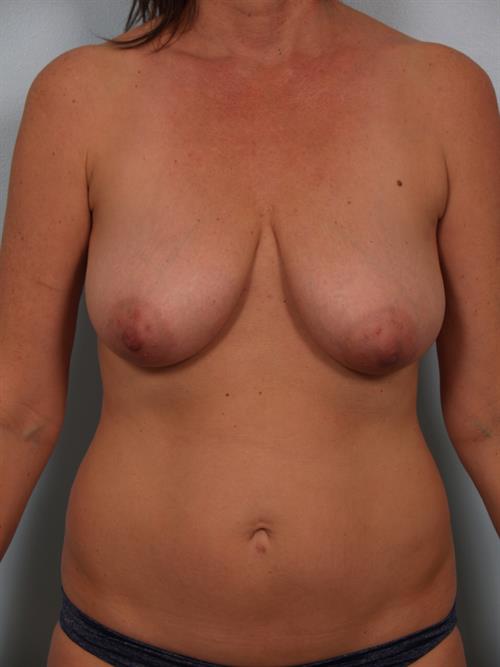 Fat Grafting Before Photo | Phoenix and Scottsdale, AZ | Scottsdale Center for Plastic Surgery