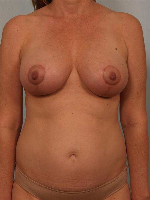 Fat Grafting After Photo | Phoenix and Scottsdale, AZ | Scottsdale Center for Plastic Surgery