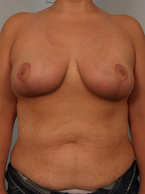 Breast Reduction After Photo | Phoenix and Scottsdale, AZ | Scottsdale Center for Plastic Surgery