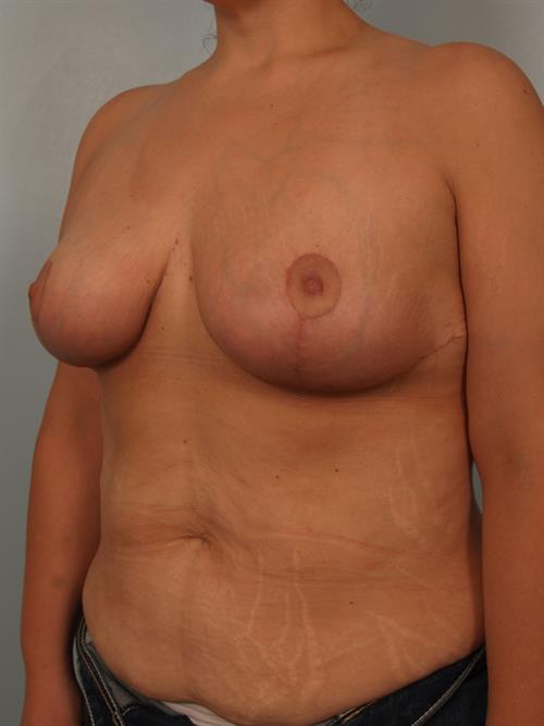 Breast Reduction After Photo | Phoenix and Scottsdale, AZ | Scottsdale Center for Plastic Surgery